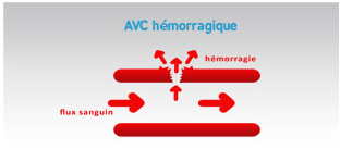 https://www.grid-france.fr/forum/img/uploads/379_avc_hemoragique.png