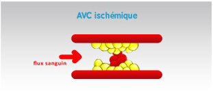 https://www.grid-france.fr/forum/img/uploads/379_avc_ischemique.png